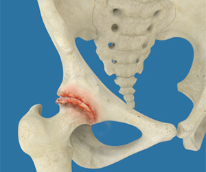 Osteoarthritis of the Hip - Educational Picture