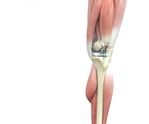 Outpatient Total Knee Replacement - Educational Picture