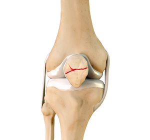 Patella Fracture - Educational Picture
