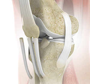 Patellar Tendon Rupture - Educational Picture