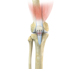 Patellar Tendon Tear - Educational Picture