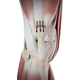 Quadriceps Tendon Repair - Educational Picture