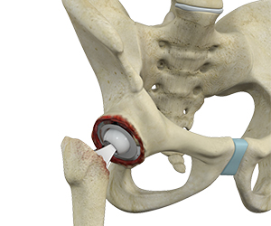 Revision Hip Replacement - Educational Picture