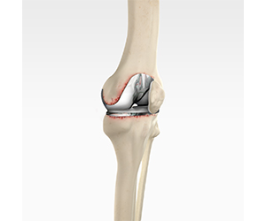 Revision Knee Replacement - Educational Picture