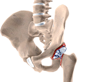 Revision Hip Surgery - Educational Picture