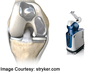 Robotic Assisted Partial Knee Replacement - Educational Picture