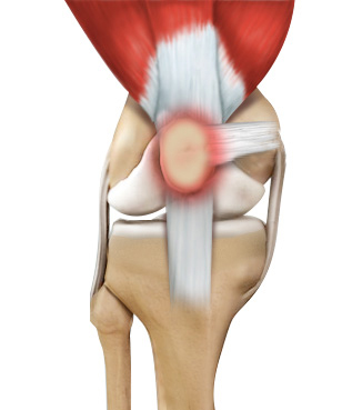 Runner's Knee - Educational Picture
