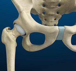 Stress Fractures of the Hip - Educational Picture