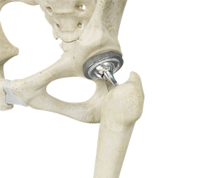 Total Hip Replacement - Educational Picture