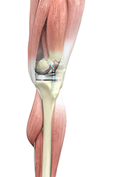 Total Knee Replacement - Educational Picture