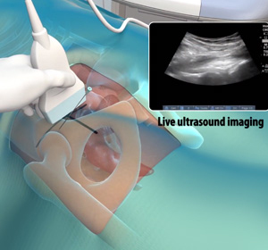Ultrasound Guided Hip Injections - Educational Picture