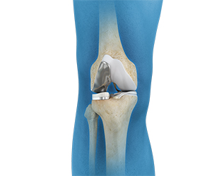 Unicompartmental/Partial Knee Replacement - Educational Picture