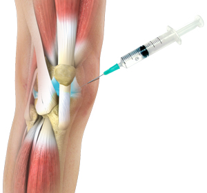 Viscosupplementation - Educational Picture