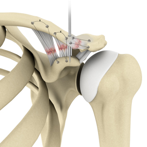 ac-joint-repair-img