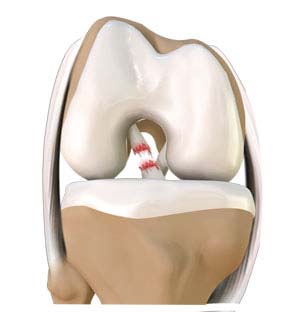 acl-tear-img