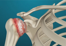 arthritis-of-the-shoulder-img-th-img