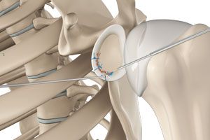 arthroscopic-bankart-repair-img