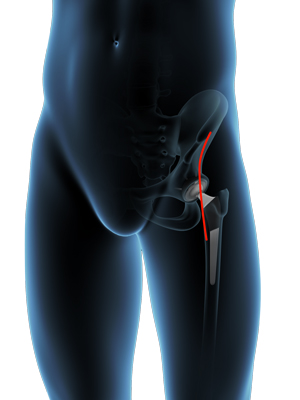 Direct Anterior Hip Replacement 