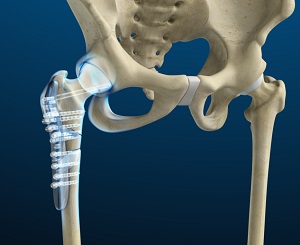 Hip Fractures Surgery 