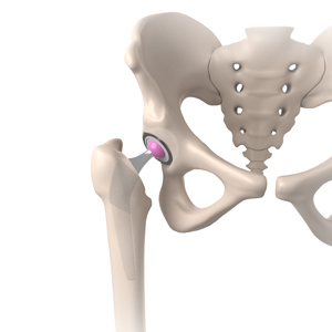 Hip Surgery 