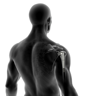Joint Replacement