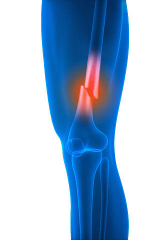 knee-fracture-s-img