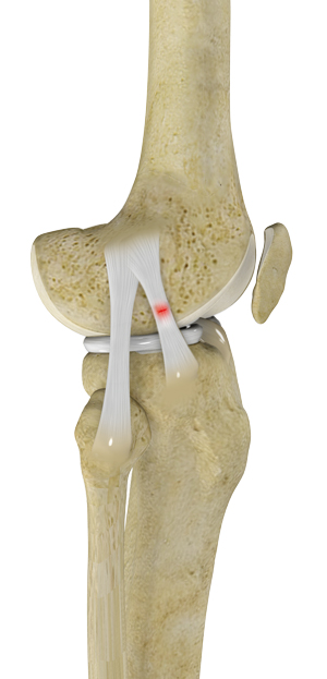knee-sprain-img