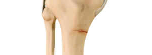 knee-stress-fractures-img