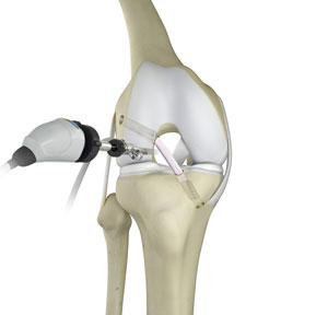 knee-trauma-reconstruction-img