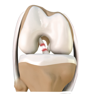 knee-trauma-img
