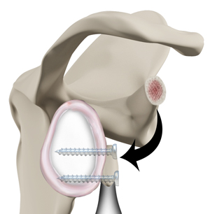 latarjet-procedure-img