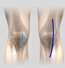 minimally-knee-replacement-img