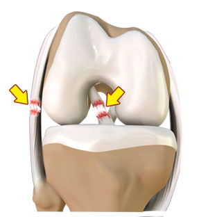 multiligament-knee-injury-img