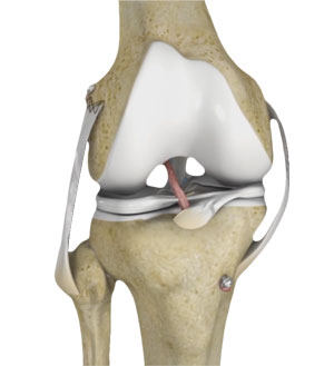 multiligament-reconstruction-of-the-knee-img
