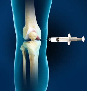 nonsurgical-knee-treatments-img