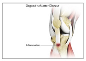 osgood-schlatter-disease-img