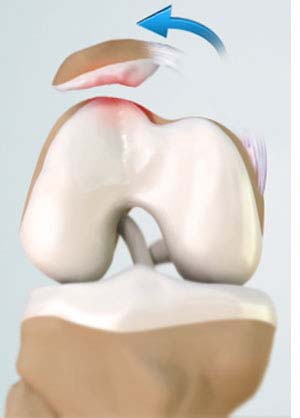 patellar-dislocation-patellofemoral-dislocation-img