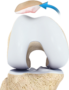 patellar-instability-img