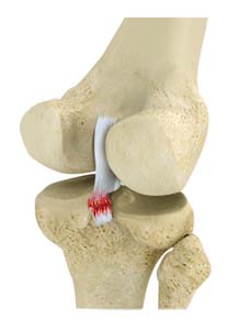 pcl-injuries-img