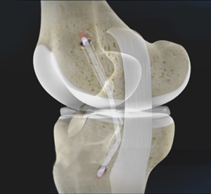 pcl-reconstruction-img