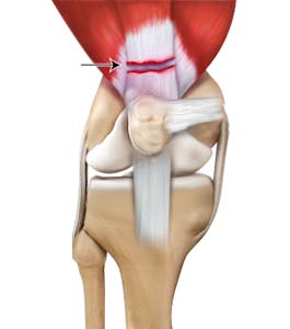 quadriceps-tendon-rupture-img