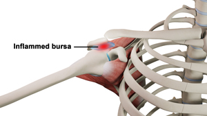 shoulder-bursitis-img