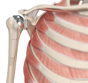 Shoulder Joint Replacement 