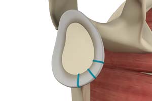 Shoulder Labrum Reconstruction 