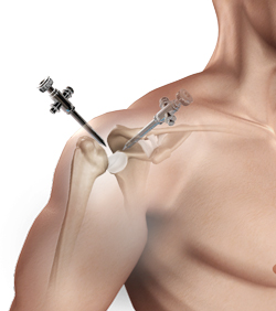 shoulder-reconstruction-img