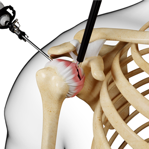 shoulder-stiffness-surgery-img