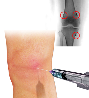 Steroid Injections
