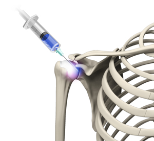 viscosupplementation-for-shoulder-arthritis-img