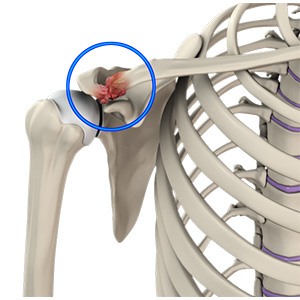 Picture of Acromioclavicular (AC) Joint Osteoarthritis