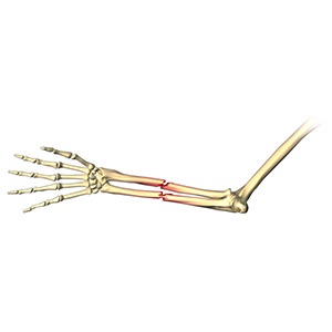 Picture of Adult Forearm Fractures